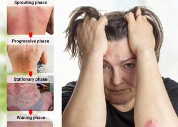 Best creams for psoriasis 2025, recommended by a dermatologist | The ...