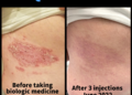 Life changing relief from biologics for our patient with plaque ...
