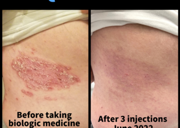 Life changing relief from biologics for our patient with plaque ...