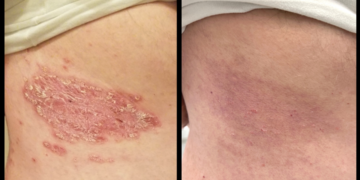 Life changing relief from biologics for our patient with plaque ...