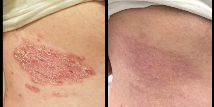 Life changing relief from biologics for our patient with plaque ...